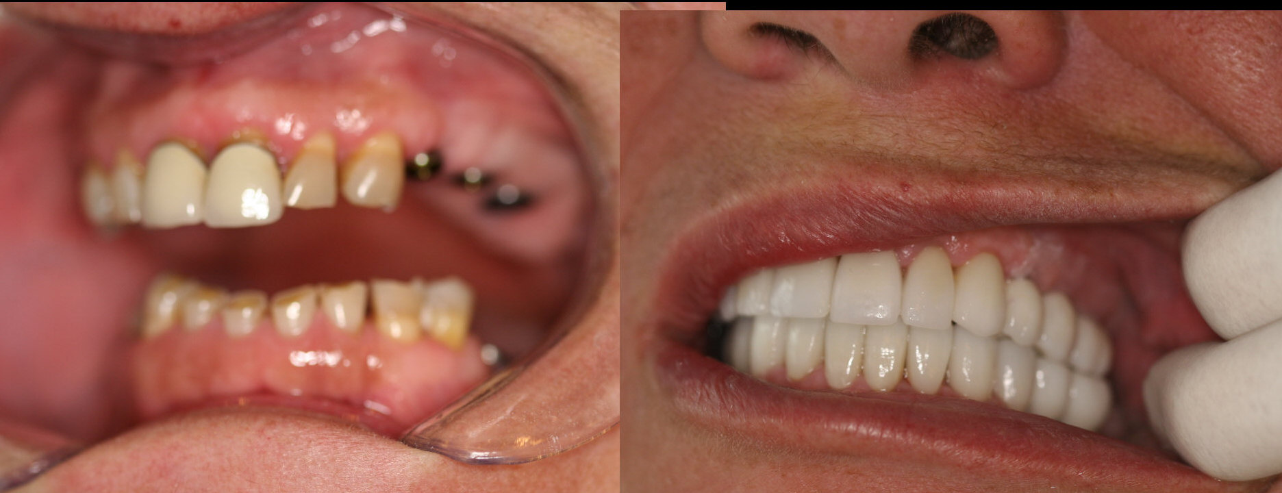 Full Mouth Implant 6