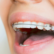 Teens & Retainers: What You Need To Know